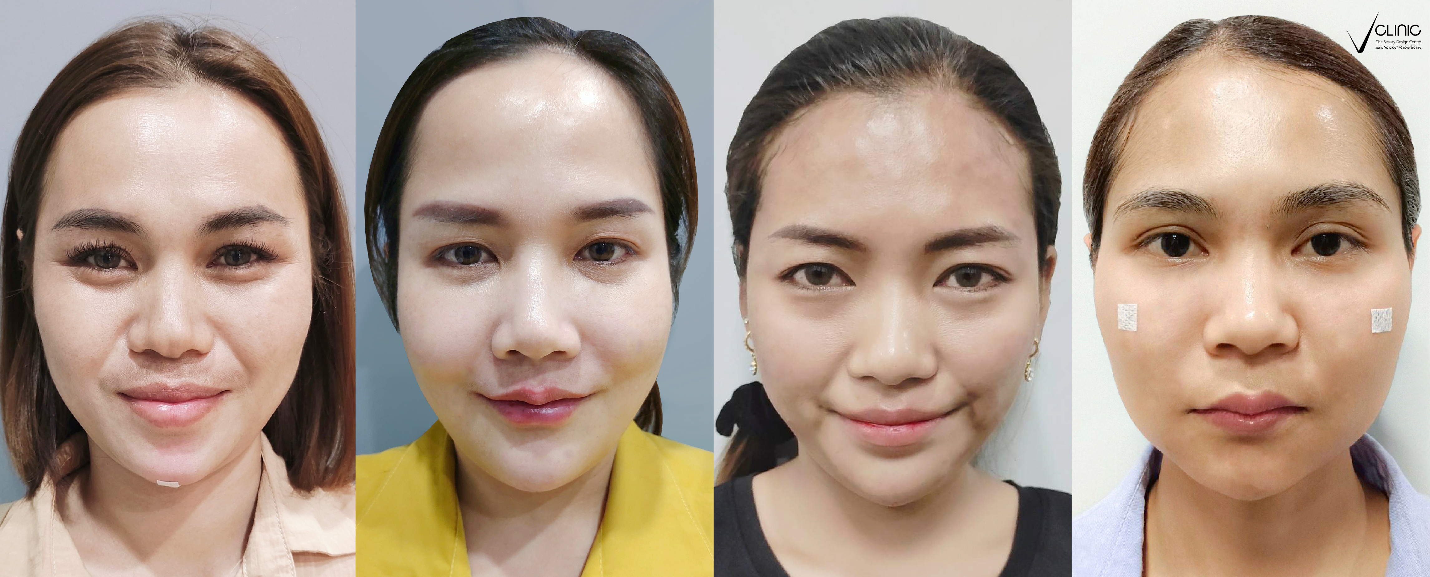 รวมรีวิวเติมฟิลเลอร์คาง